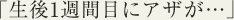 生後1週間目にアザが・・・