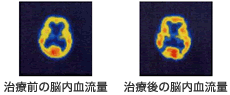 治療前の脳内血流量／治療後の脳内血流量